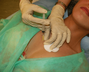 A mezokoktél bevezetése a mellszövetbe – a hialuronsav injekciók alternatívája