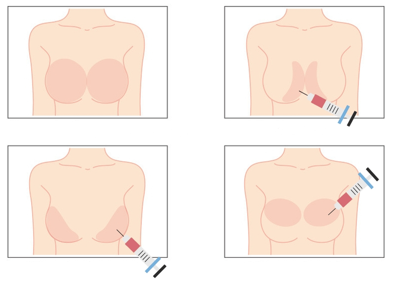 Helyek a hialuronsav mellbe történő befecskendezésére