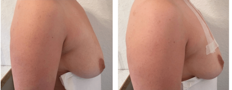 Menetes mellemelés előtt és után