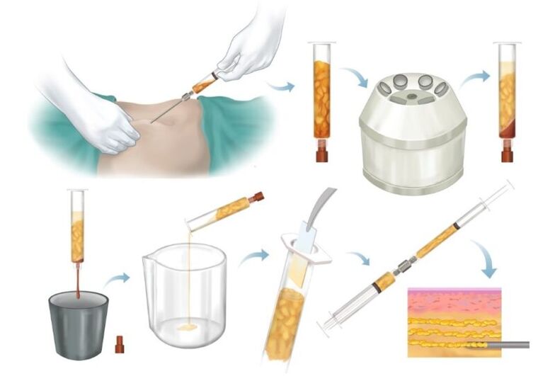 Zsír eltávolítása a problémás területekről, feldolgozás és injekció a mellszövetbe