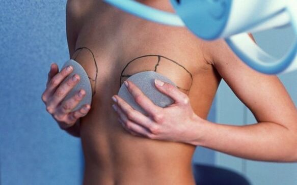 mellnagyobbítás implantátumokkal