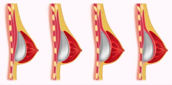 mellnagyobbító implantátumok behelyezésének módszerei